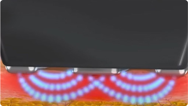inmode_img
