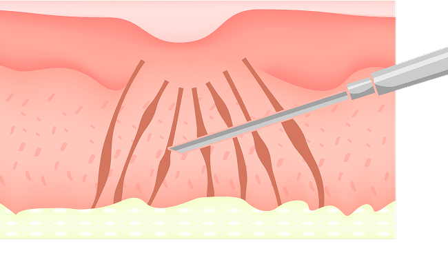 subcision_img