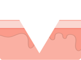 subcision_img