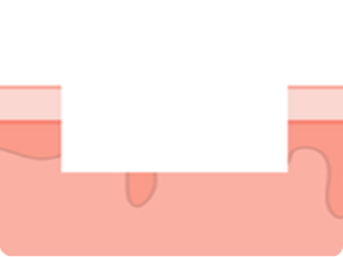 subcision_img