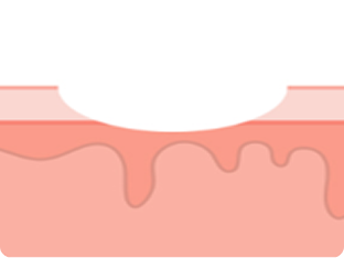subcision_img