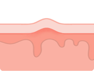 subcision_img