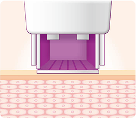 thermage_img