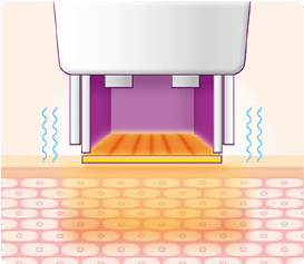 thermage_img