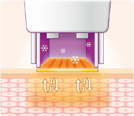 thermage_img