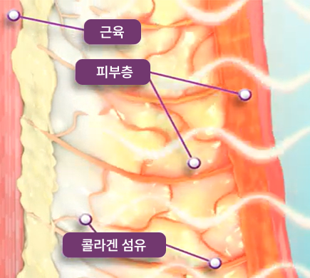 thermage_img