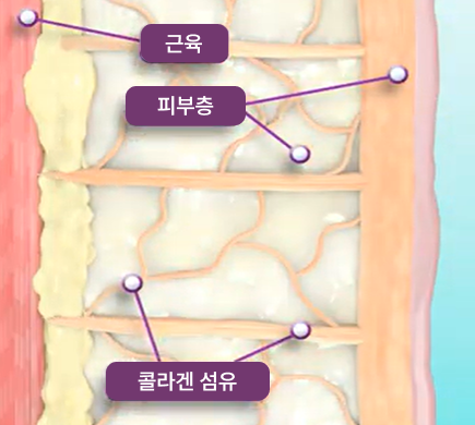 thermage_img